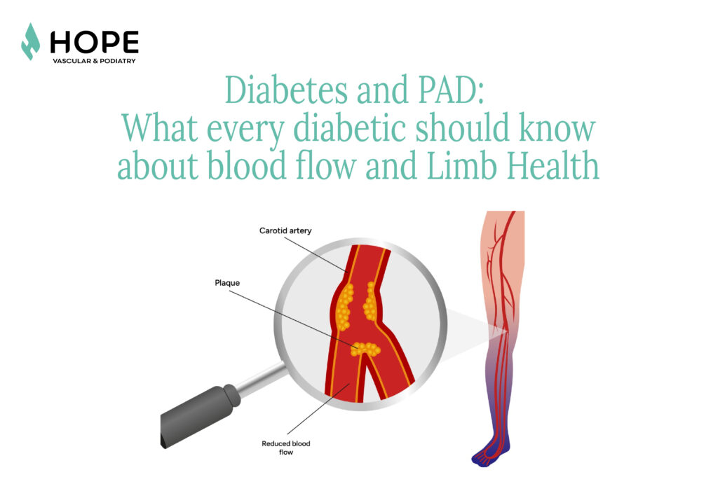 Diagram showing the link between diabetes and PAD, with a magnified view of artery plaque and reduced blood flow in a labeled leg carotid artery, highlighting how compression stockings benefits may help improve circulation.